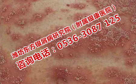 红皮型银屑病总是反复的原因