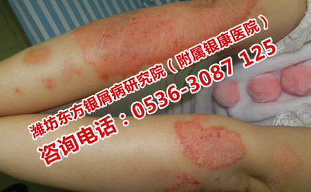 预防孩子遗传父母银屑病