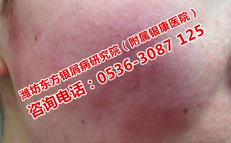 女性银屑病可以采用其他方治