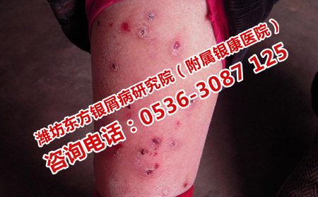 帮助银屑病治疗的护理办法