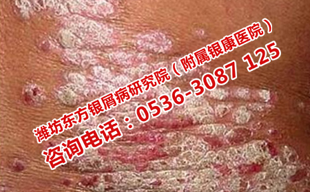 银屑病临床恢复率