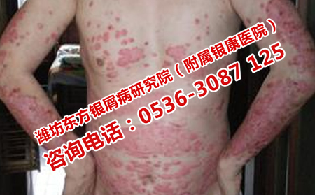 安丘治疗脓疱性银屑病