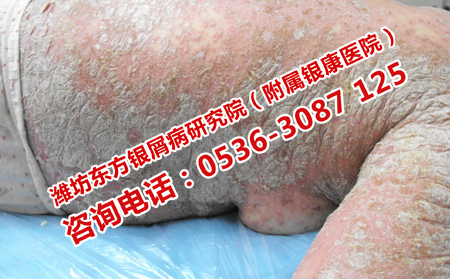 银屑病怎么预防复发