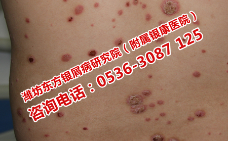 银屑病可以预防复发吗