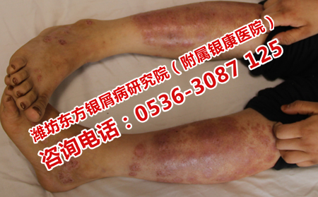 吃什么对银屑病可以