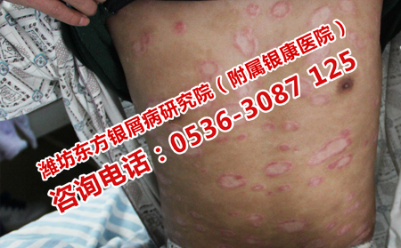 寒亭区哪位医生治银屑病可以