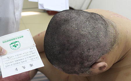 头部银屑病平时如何护理