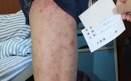吸烟会导致银屑病吗