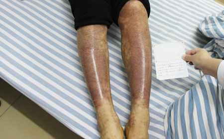 银屑病生活健康