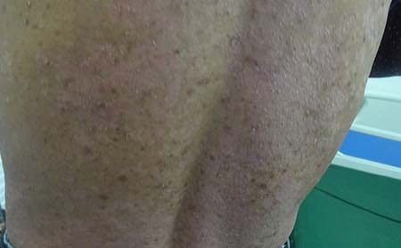 银屑病的外部症状
