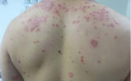牛皮癣的治疗