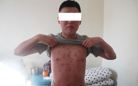 关于银屑病的常识
