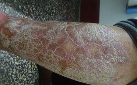 牛皮癣治疗