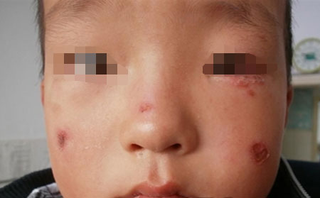 银屑病患者应该少洗澡吗