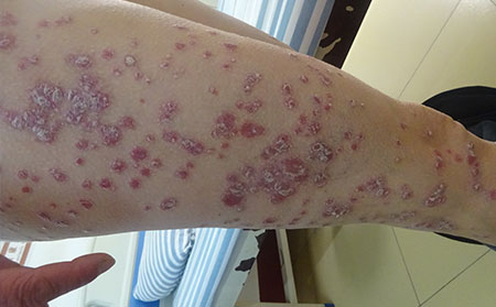 钱币状银屑病患者的症状和防护