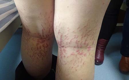 银屑病护理方法