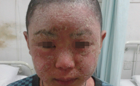 银屑病的危害有什么