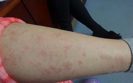 儿童银屑病症状,儿童得银屑病表现